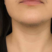 Vello facial oscuro en la cara